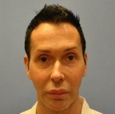 Rhinoplasty before at Hankins & Sohn Plastic Surgery Associates in Henderson, NV