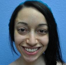 Hankins & Sohn Plastic Surgery Associates rhinoplasty after — Las Vegas, NV