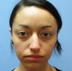 Rhinoplasty before at Hankins & Sohn Plastic Surgery Associates in Henderson, NV