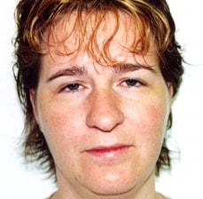 Rhinoplasty before at Hankins & Sohn Plastic Surgery Associates in Henderson, NV