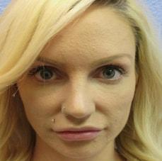 Hankins & Sohn Plastic Surgery Associates rhinoplasty after — Las Vegas, NV