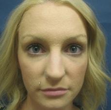 Rhinoplasty before at Hankins & Sohn Plastic Surgery Associates in Henderson, NV