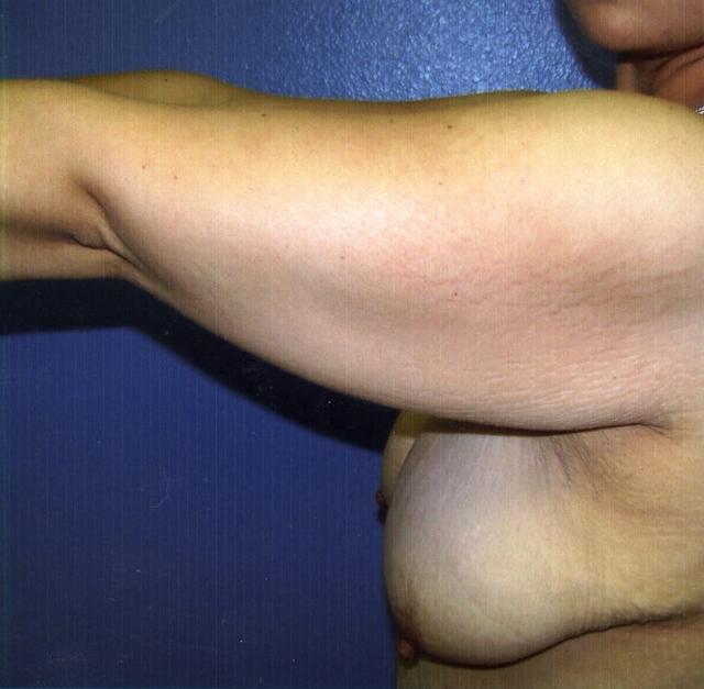 Thigh Lift before at Hankins & Sohn Plastic Surgery Associates in Henderson, NV