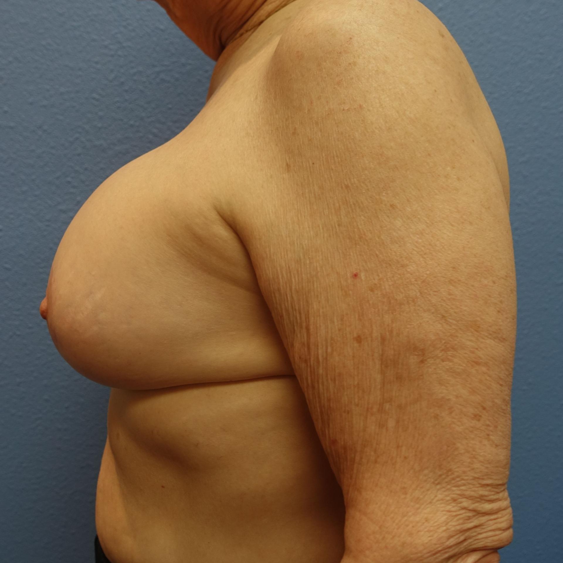 Hankins & Sohn Plastic Surgery Associates breast lift after — Henderson, NV