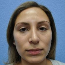 Hankins & Sohn Plastic Surgery Associates rhinoplasty after — Las Vegas, NV