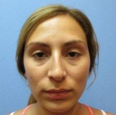 Rhinoplasty before at Hankins & Sohn Plastic Surgery Associates in Henderson, NV