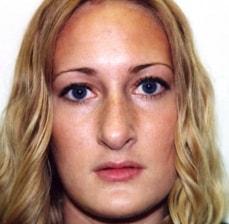 Rhinoplasty before at Hankins & Sohn Plastic Surgery Associates in Henderson, NV
