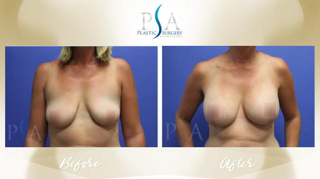 Breast Augmentation result at Plastic Surgery Associates of Orange County in Mission Viejo, CA