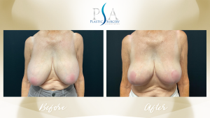 Plastic Surgery Associates of Orange County after — Mission Viejo, CA