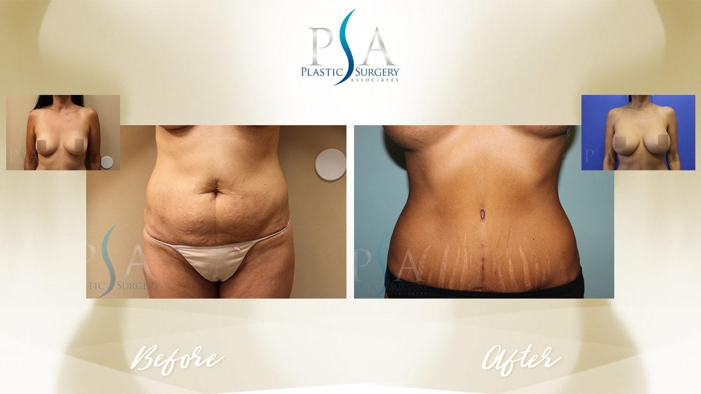Plastic Surgery Associates of Orange County mommy makeover result — Mission Viejo, CA