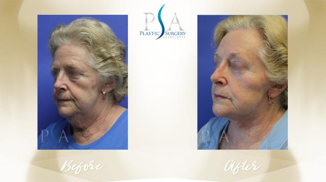 Deep Plane Facelift result at Plastic Surgery Associates of Orange County in Mission Viejo, CA