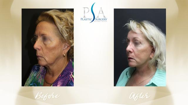 Deep Plane Facelift result at Plastic Surgery Associates of Orange County in Mission Viejo, CA