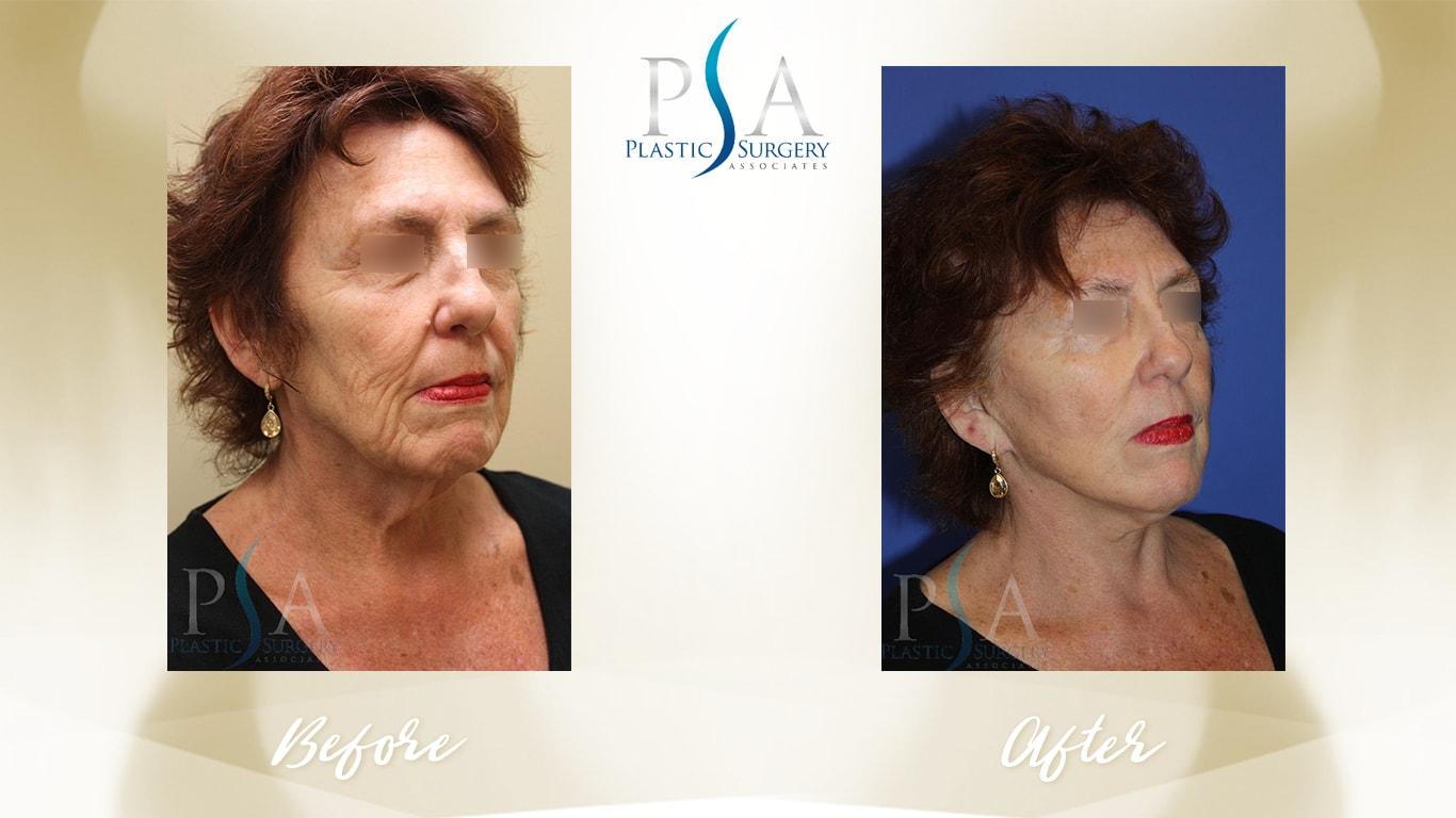 Plastic Surgery Associates of Orange County facelift result — Mission Viejo, CA