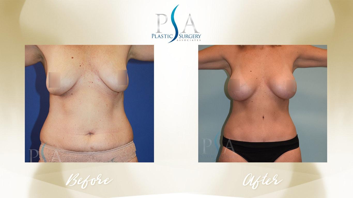 Plastic Surgery Associates of Orange County mommy makeover result — Mission Viejo, CA