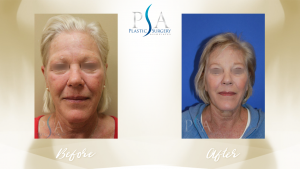 Plastic Surgery Associates of Orange County after — Mission Viejo, CA