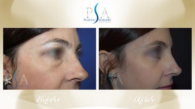 Blepharoplasty result at Plastic Surgery Associates of Orange County in Mission Viejo, CA
