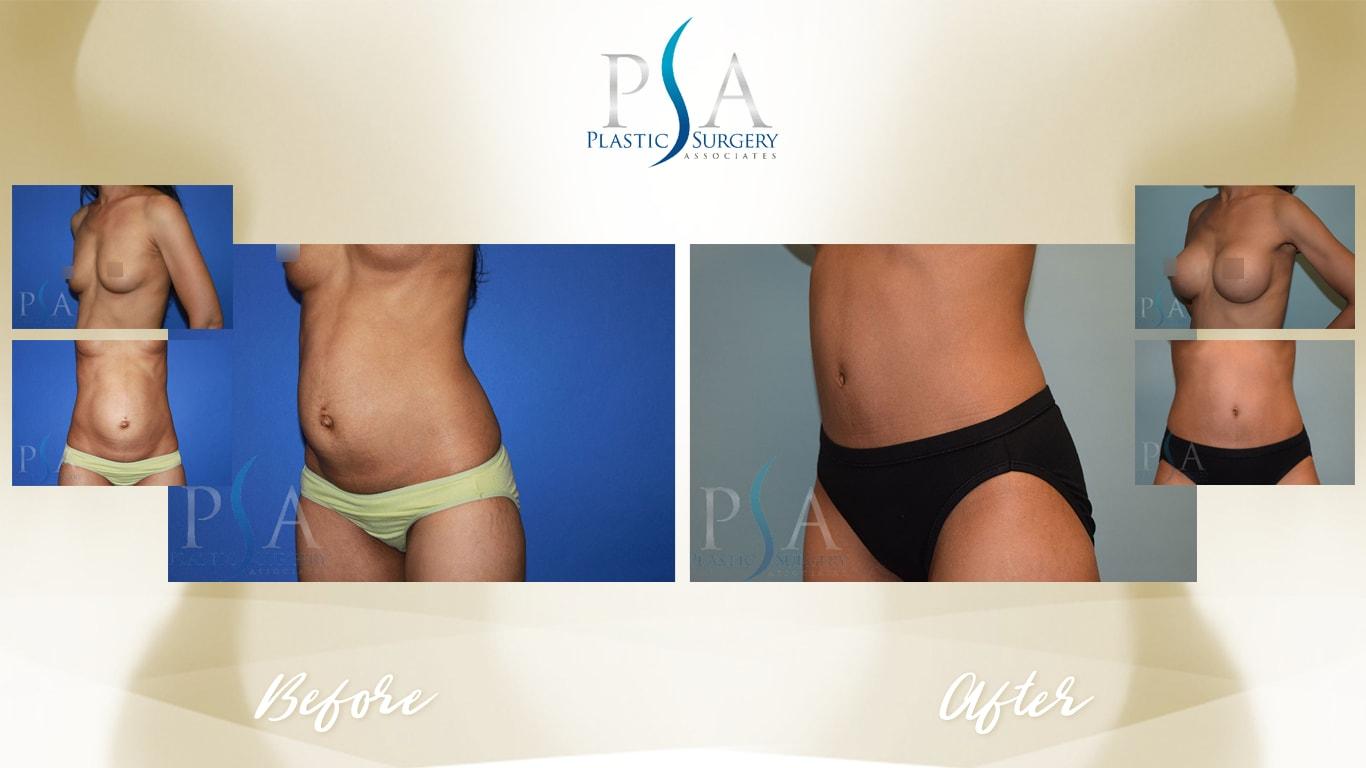 Plastic Surgery Associates of Orange County mommy makeover result — Mission Viejo, CA