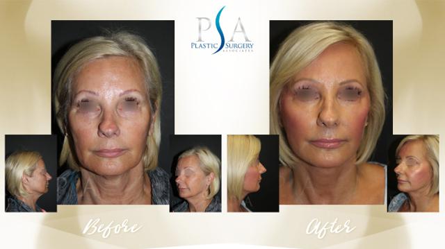 Deep Plane Facelift result at Plastic Surgery Associates of Orange County in Mission Viejo, CA