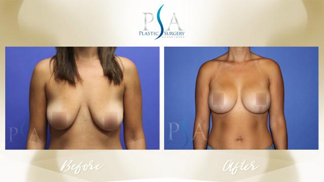 Breast Augmentation result at Plastic Surgery Associates of Orange County in Mission Viejo, CA