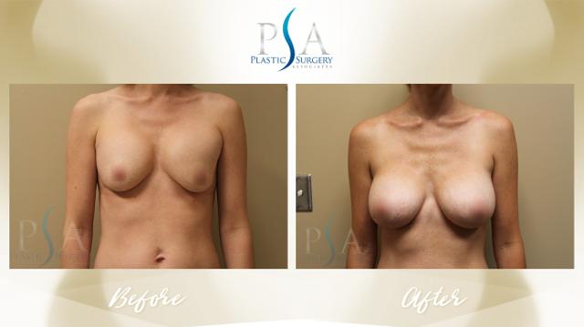 Breast Augmentation result at Plastic Surgery Associates of Orange County in Mission Viejo, CA