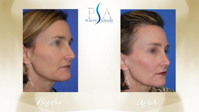 Deep Plane Facelift result at Plastic Surgery Associates of Orange County in Mission Viejo, CA