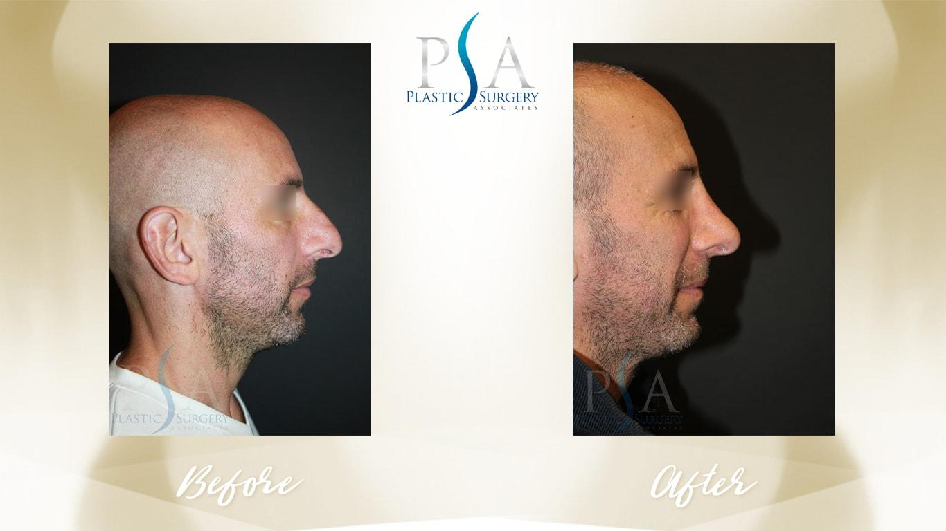 Plastic Surgery Associates of Orange County rhinoplasty result — Mission Viejo, CA
