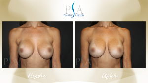 Plastic Surgery Associates of Orange County after — Mission Viejo, CA