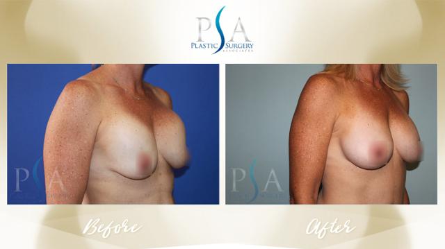 Breast Augmentation result at Plastic Surgery Associates of Orange County in Mission Viejo, CA