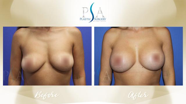 Breast Augmentation result at Plastic Surgery Associates of Orange County in Mission Viejo, CA