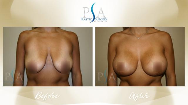Breast Augmentation result at Plastic Surgery Associates of Orange County in Mission Viejo, CA