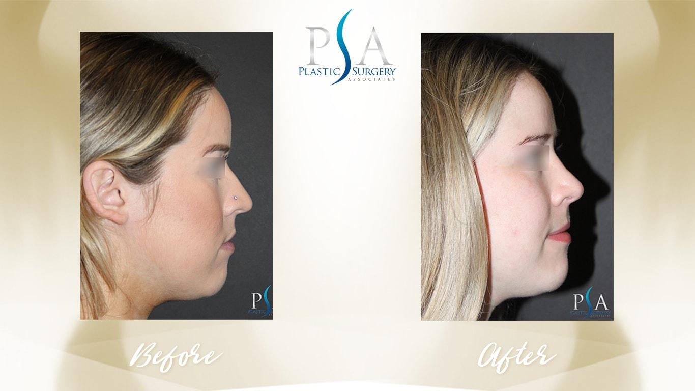 Plastic Surgery Associates of Orange County rhinoplasty result — Mission Viejo, CA