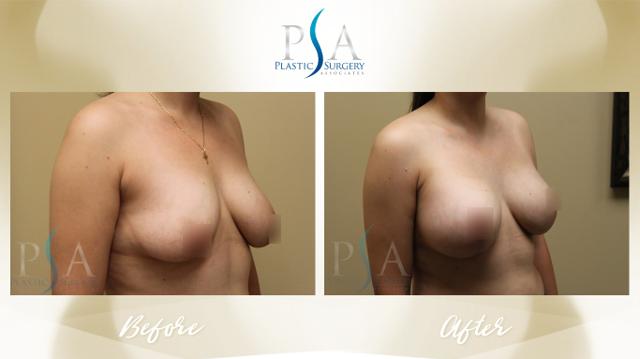 Breast Augmentation result at Plastic Surgery Associates of Orange County in Mission Viejo, CA