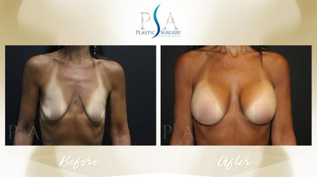 Breast Augmentation result at Plastic Surgery Associates of Orange County in Mission Viejo, CA