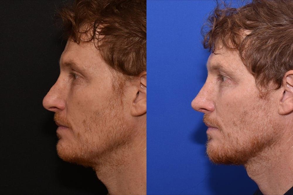 David J. Phillips, MD rhinoplasty result — New York, NY