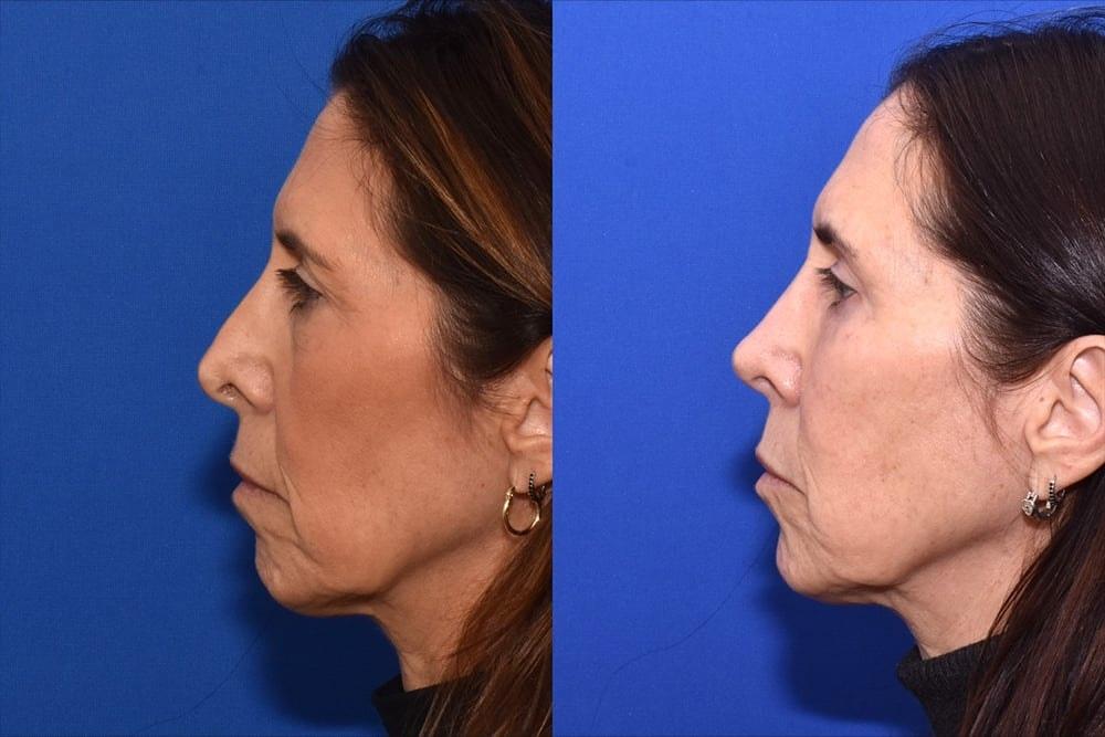 David J. Phillips, MD rhinoplasty result — New York, NY