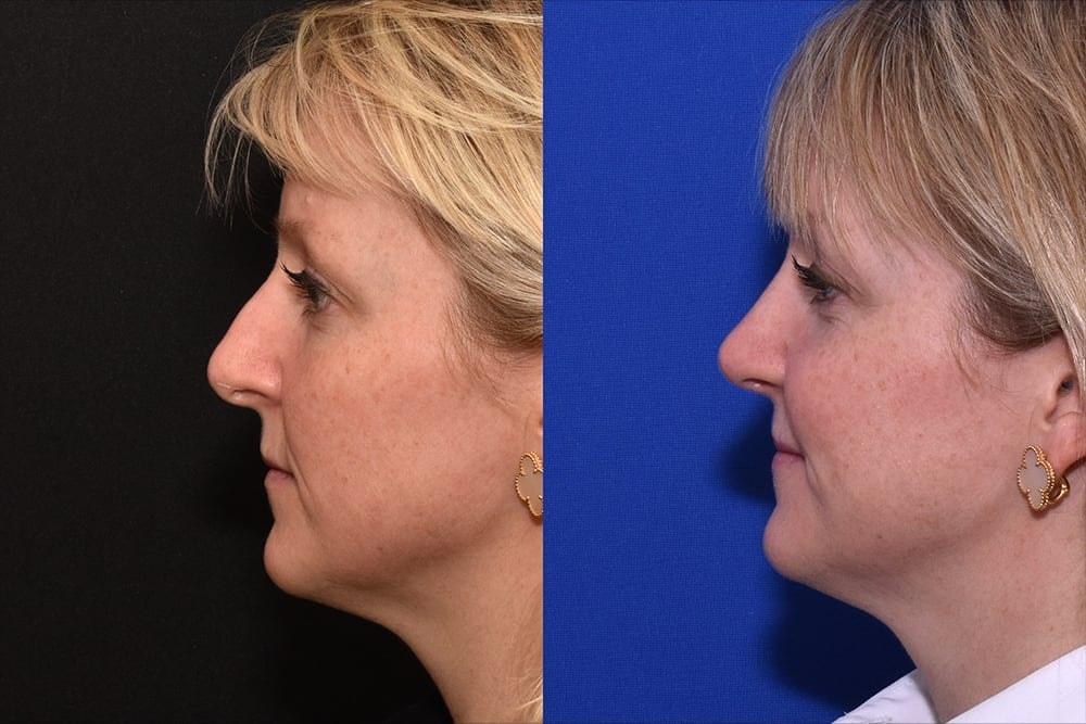David J. Phillips, MD rhinoplasty result — New York, NY