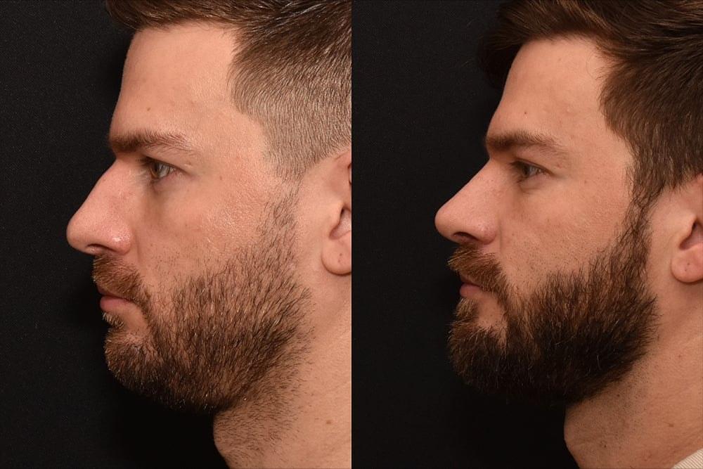 David J. Phillips, MD rhinoplasty result — New York, NY