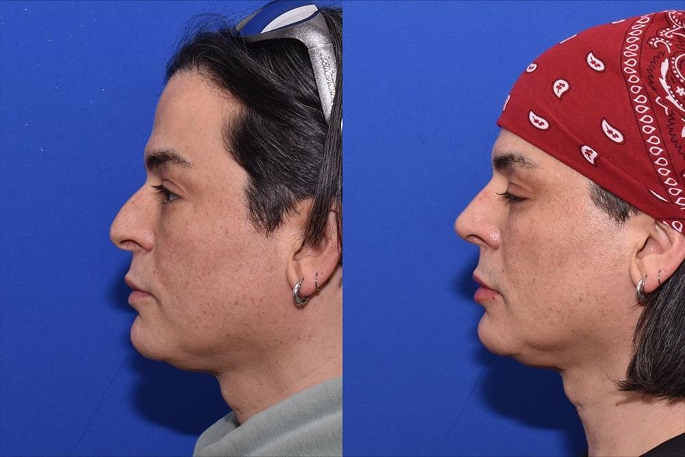 David J. Phillips, MD rhinoplasty result — New York, NY