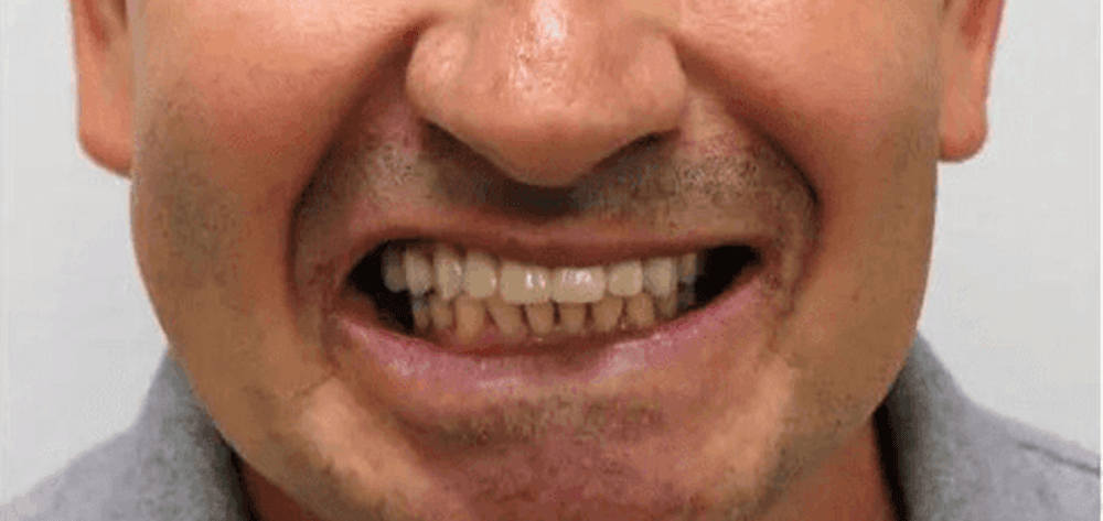 Dental Design Studios (Dentista) smile makeover after — Nashville, TN