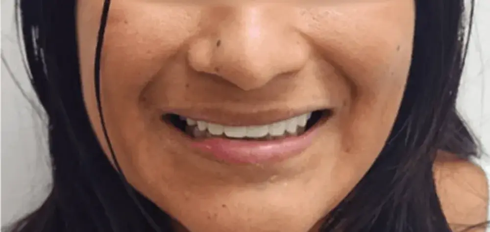 Dental Design Studios (Dentista) smile makeover after — Nashville, TN