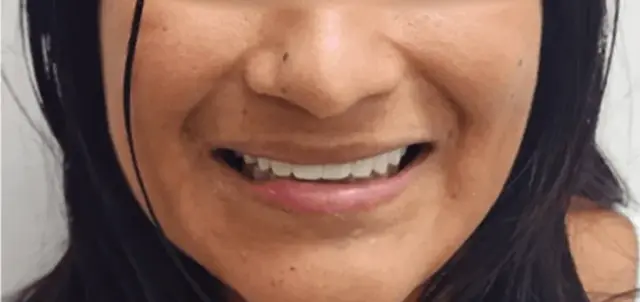 Dental Veneers after at Dental Design Studios (Dentista) in Nashville, TN