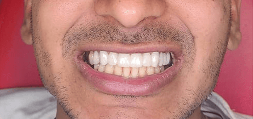 Dental Design Studios (Dentista) smile makeover after — Nashville, TN