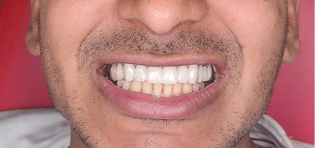 Smile Makeover after at Dental Design Studios (Dentista) in Nashville, TN