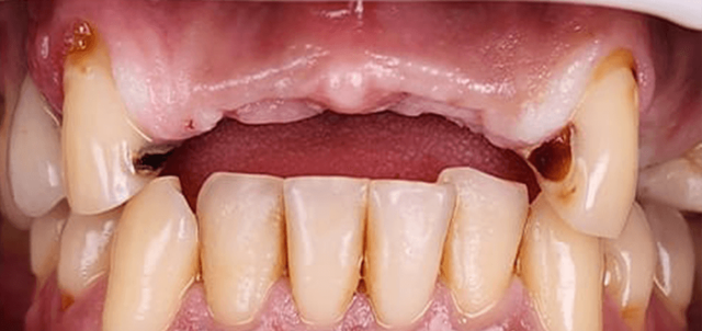 Smile Makeover before at Dental Design Studios (Dentista) in Nashville, TN