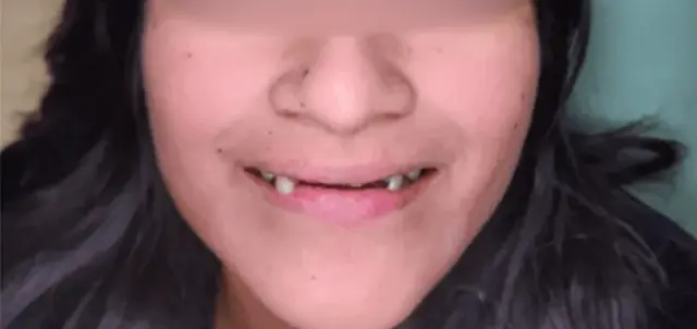 Dental Veneers before at Dental Design Studios (Dentista) in Nashville, TN