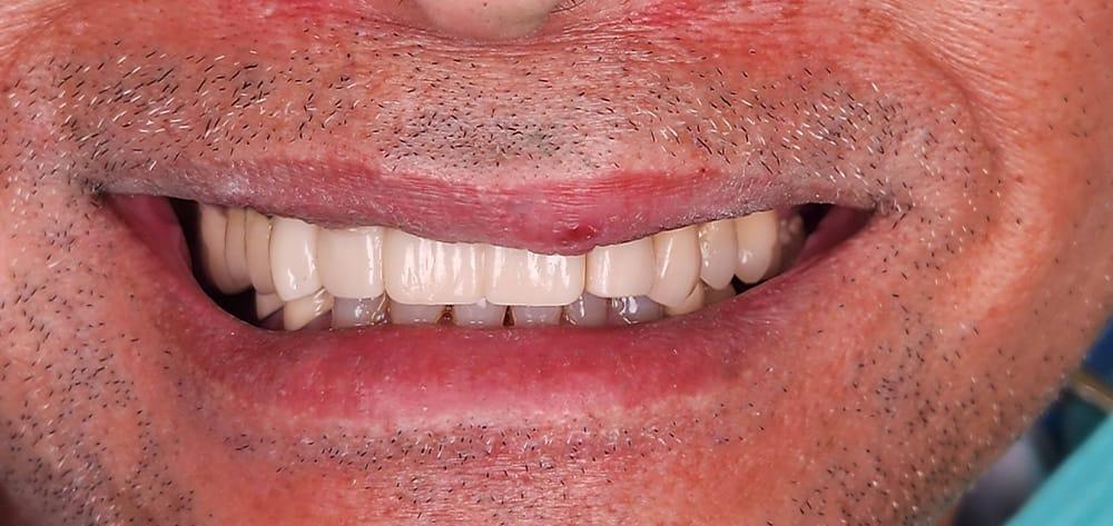 Dental Design Studios (Dentista) smile makeover after — Nashville, TN