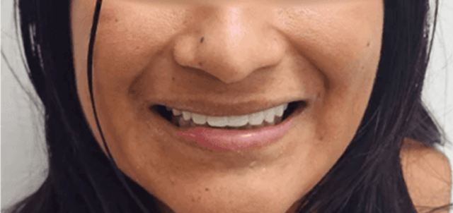 Smile Makeover after at Dental Design Studios (Dentista) in Nashville, TN