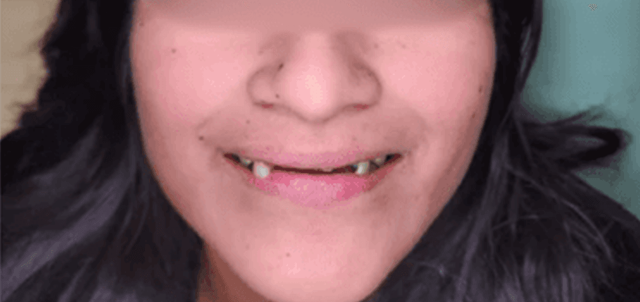 Smile Makeover before at Dental Design Studios (Dentista) in Nashville, TN