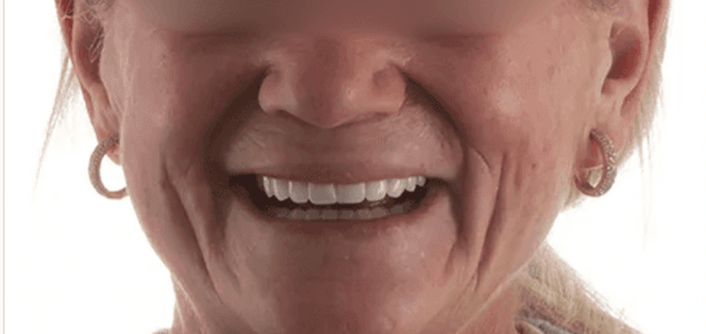 Dental Design Studios (Dentista) smile makeover after — Nashville, TN