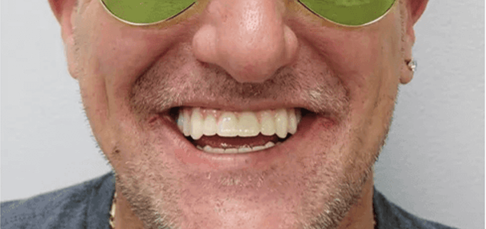 Dental Design Studios (Dentista) smile makeover after — Nashville, TN